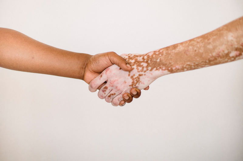 Komitmen Edukasi dan Penyediaan Terapi Kombinasi untuk Vitiligo di World Vitiligo Month